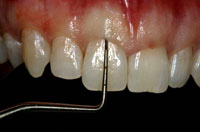 Remodelage gingival