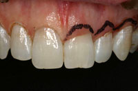 Remodelage gingival